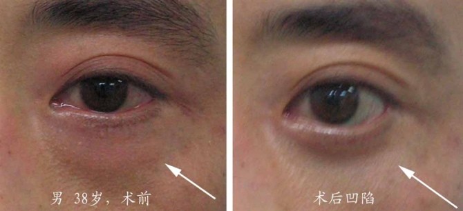 超声法祛眼袋,眼底凹陷是手术失败了吗?